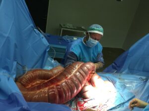 kolik operation